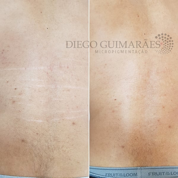 Tem estrias e gostaria de neutralizá-las? Com a micropigmentação, conseguimos uniformizar o tom em até 80%! Esse caso está cicatrizado há 60 dias e o resultado ficou impressionante. #micropigmentação #micropigmentaçãodeestrias #micropigmentaçãocicatrizada #estrias #camuflagemdeestrias #diegoguimarães