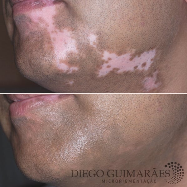 É possível camuflar manchas e vitiligo! Saiba mais, acesse: www.diegoguimaraes.com.br 😷✌ #vitiligo #camuflagemdevitiligo #micropigmentação #autoestima #diegoguimarães